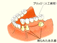 ブリッジ