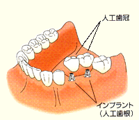 インプラント