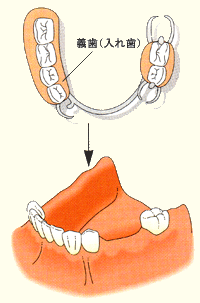 義歯（入れ歯）