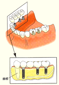 インプラント